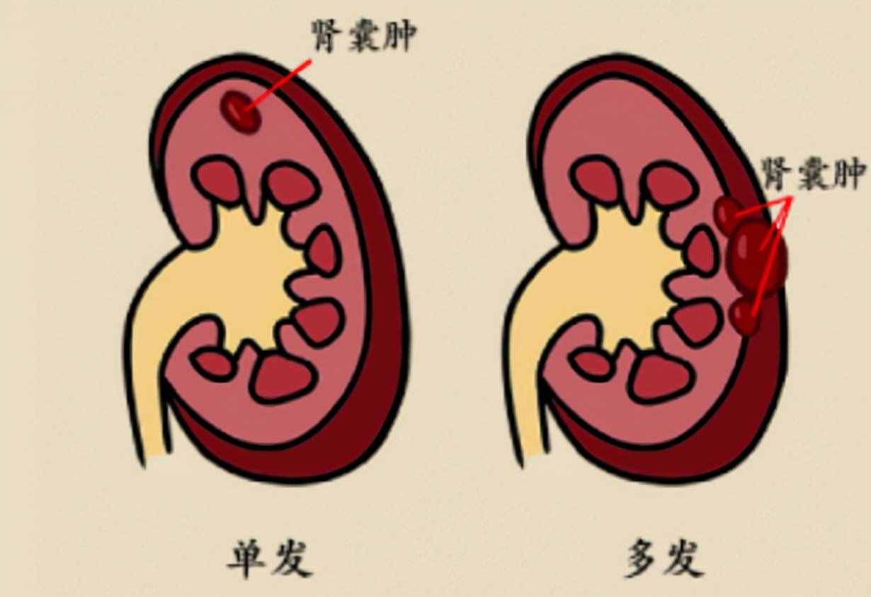 肾囊肿影响大，生活中预防是关键！另附不手术消除的方法