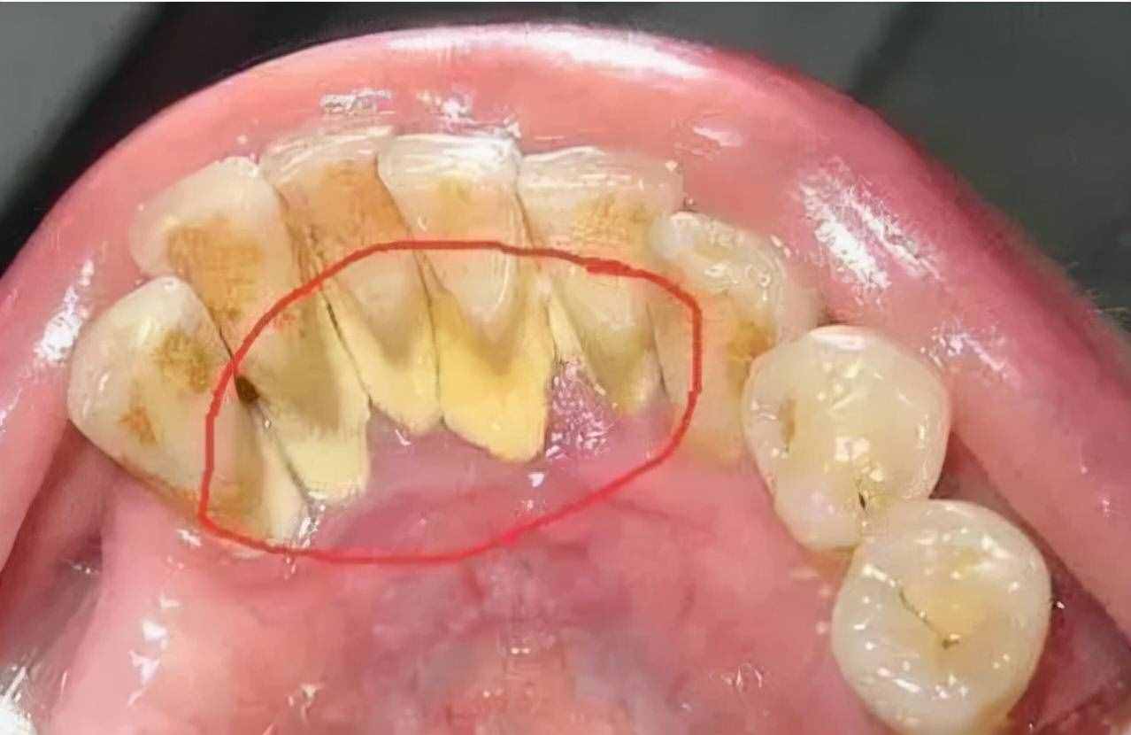 “牙结石”可以自己抠掉吗？教你一招，牙缝的脏东西或能轻松掉