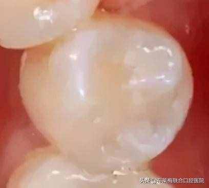 牙齿表面被蛀坏了一大半，怎么办？