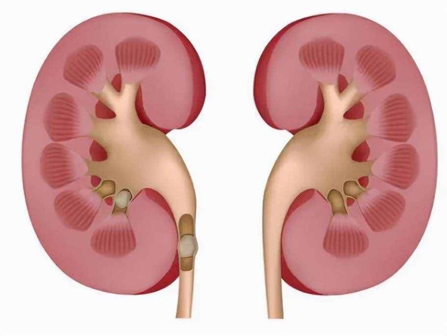 肾囊肿影响大，生活中预防是关键！另附不手术消除的方法