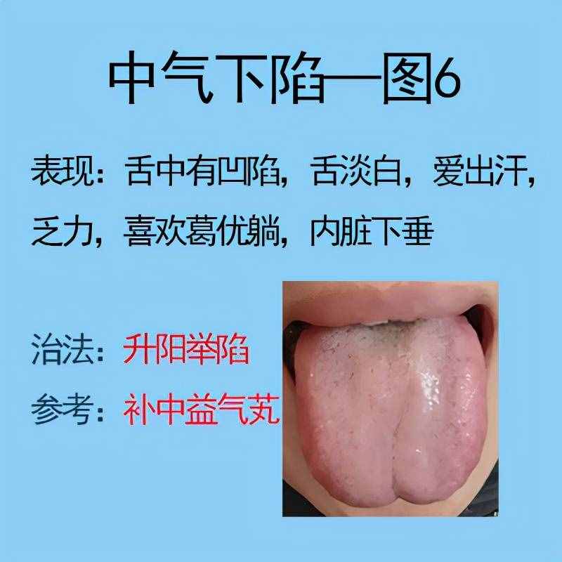 脾胃不好常见6种舌象，比如脾气虚，脾阳虚等，后面有解决方法