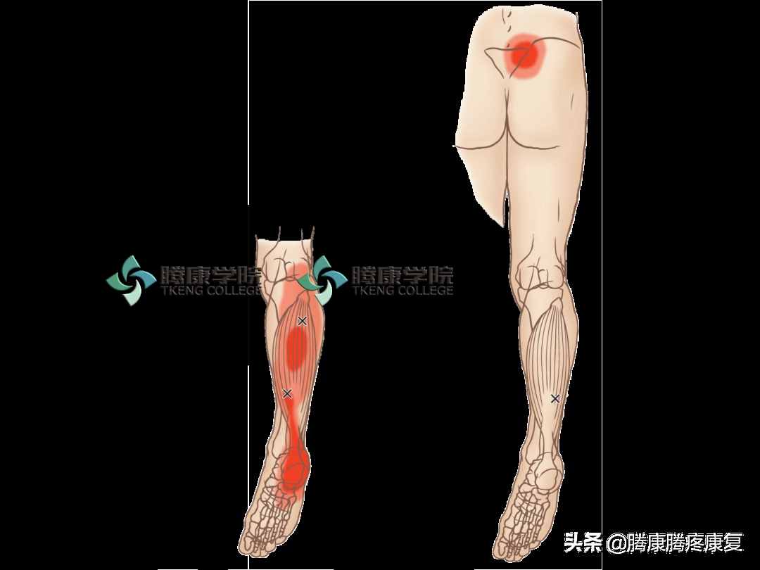 导致小腿疲劳酸痛的关键肌——小腿三头肌