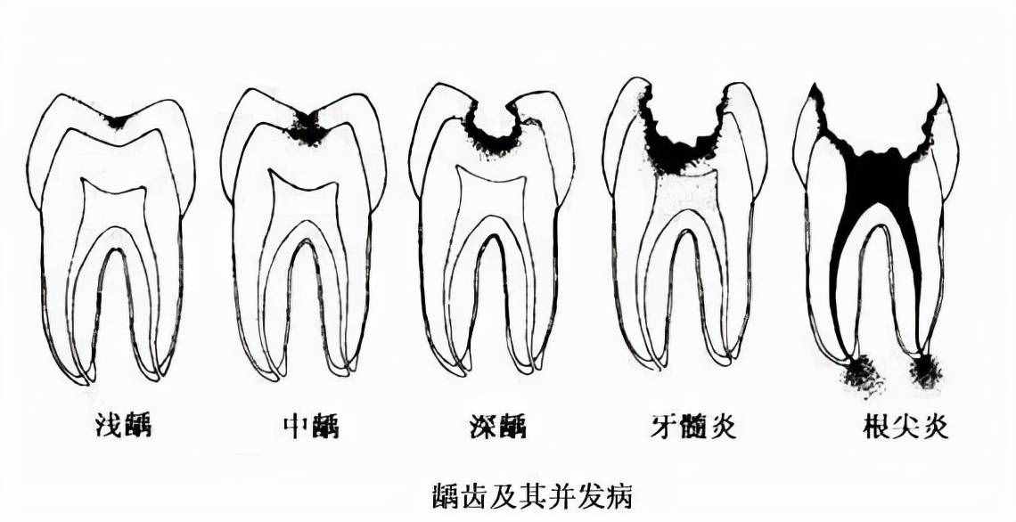 牙齿都烂了一半，为什么不能直接补牙？