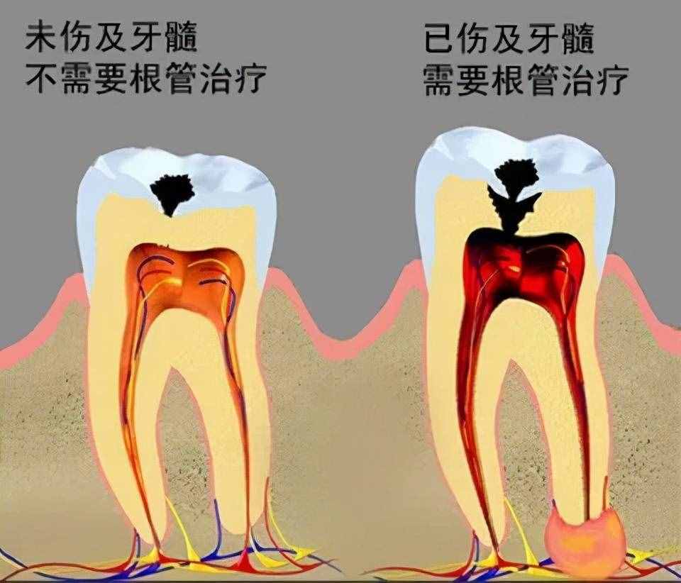 牙齿都烂了一半，为什么不能直接补牙？