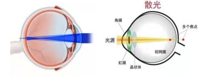 孩子散光怎么办？有可能彻底恢复吗