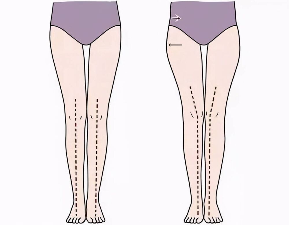 让你的腿变长显瘦第一步，不是减脂，而是消除假胯，3个动作搞定