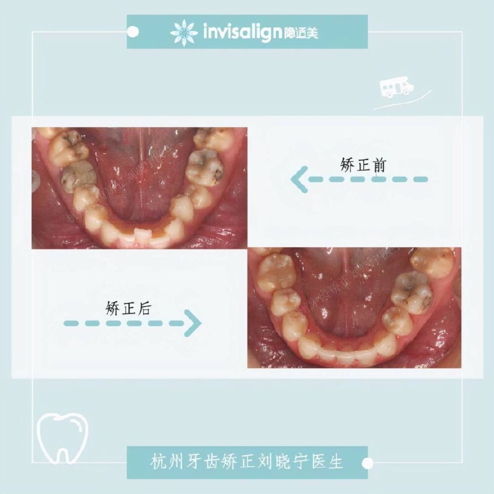 杭州牙齿矫正丨露龈笑怎么办？全面告别露龈笑的4大方法