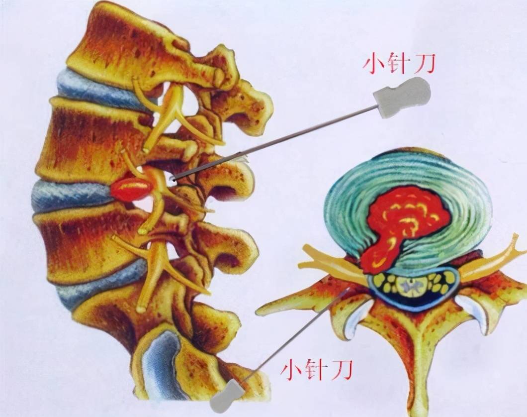 颈椎生理曲度变直还能恢复吗？该如何进行恢复？