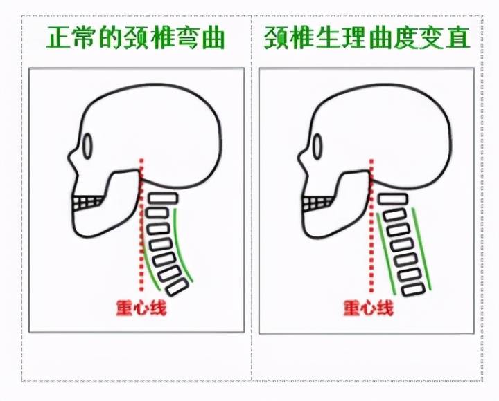 颈椎生理曲度变直怎么办？别担心还有救，还能弯回来