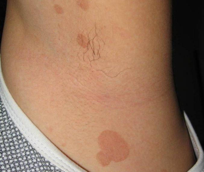 夏天腋下、肩背部长褐色或白色的斑疹，不痛不痒，可能是汗斑