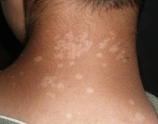 夏天腋下、肩背部长褐色或白色的斑疹，不痛不痒，可能是汗斑