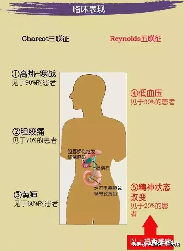 什么是Murphy征、Charcot三联征？谈胆囊炎与胆管炎的典型症状