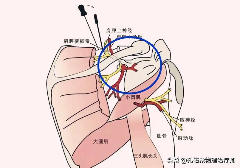 肩周炎是导致肩痛的原因，结果大家都进入误区，咋不想想其他病因