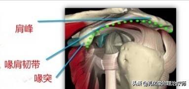 肩周炎是导致肩痛的原因，结果大家都进入误区，咋不想想其他病因