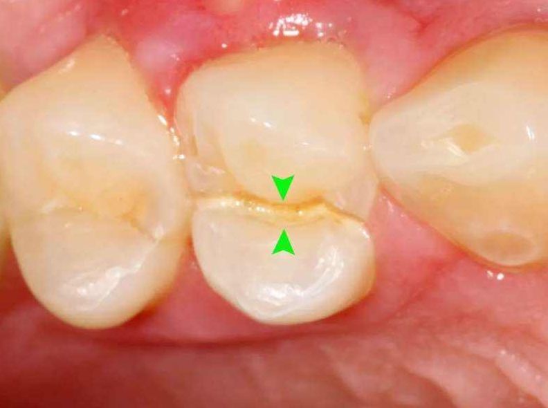 牙齿酸疼影响日常饮食，真的是仅是敏感问题吗？牙医教你怎么解决