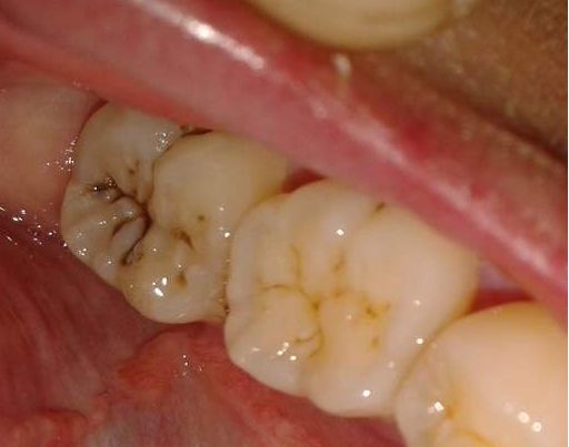 牙齿酸疼影响日常饮食，真的是仅是敏感问题吗？牙医教你怎么解决