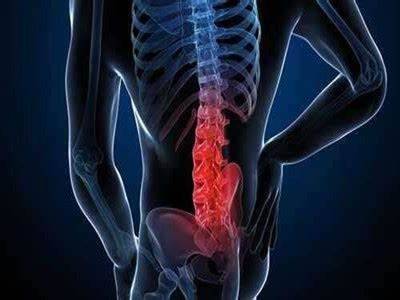 我怎么患上了强直性脊柱炎？难道是最近摔伤了腰，不一定是这样