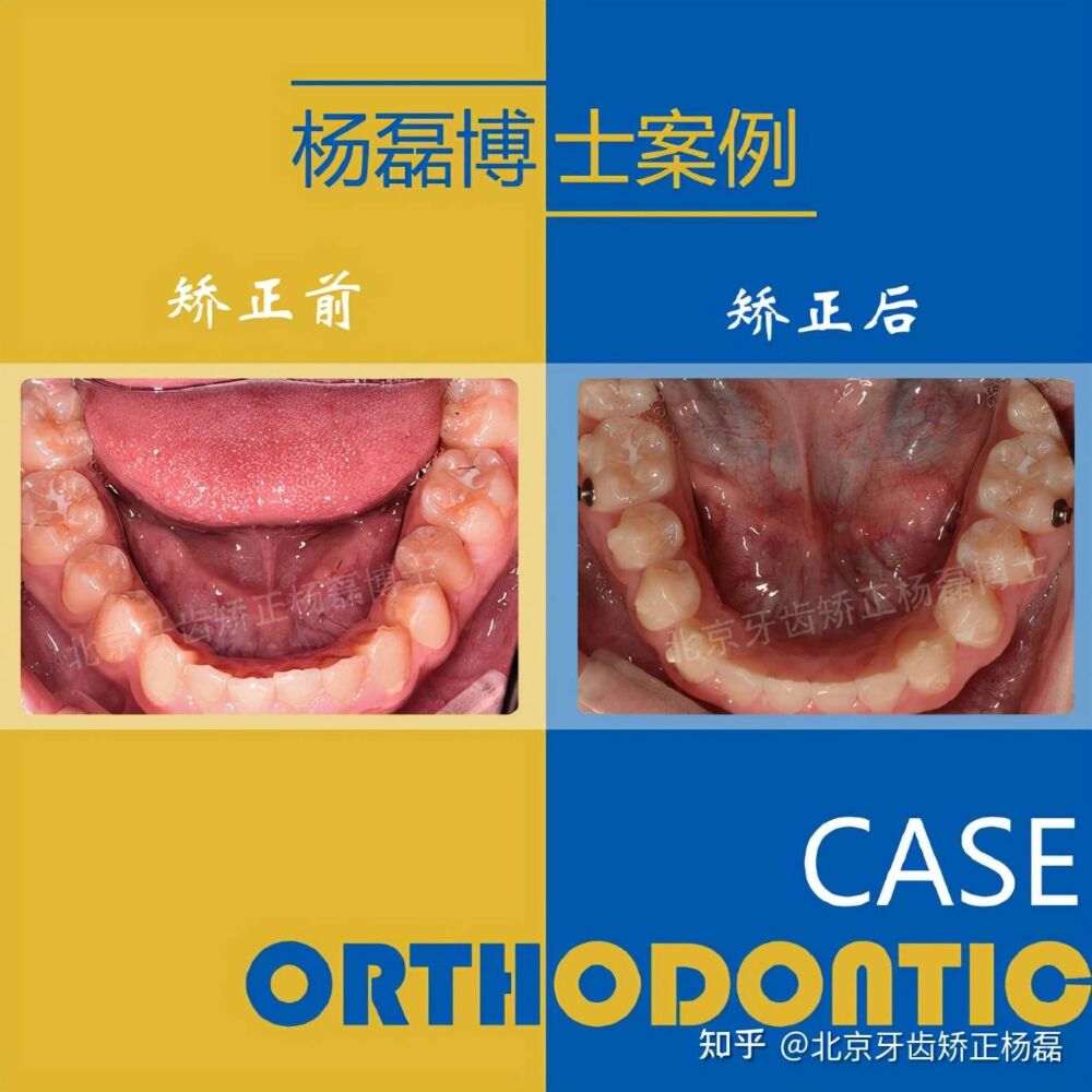 北京牙齿矫正｜隐适美不拔牙正畸改善龅牙嘴突笑线不调