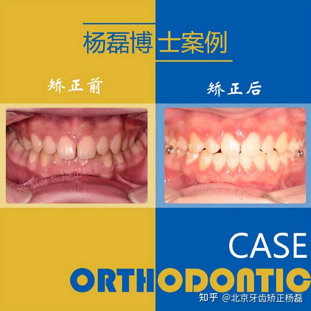 北京牙齿矫正｜隐适美不拔牙正畸改善龅牙嘴突笑线不调
