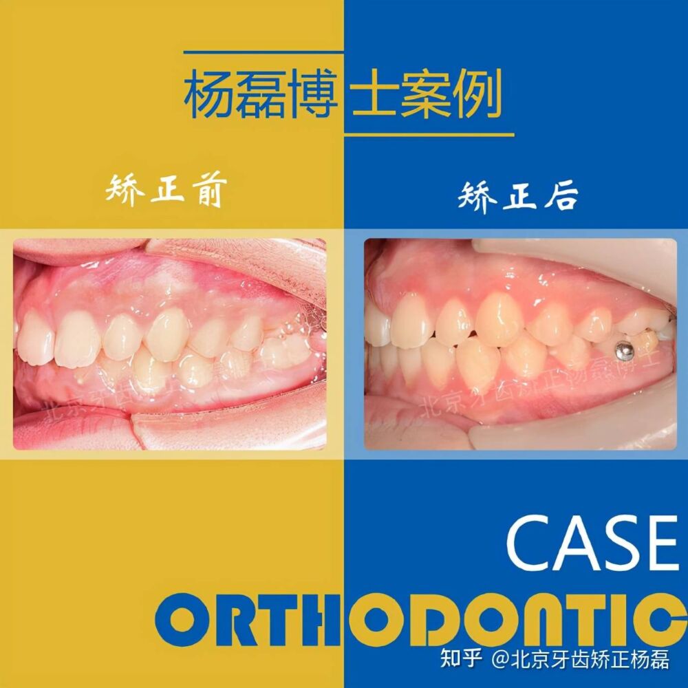 北京牙齿矫正｜隐适美不拔牙正畸改善龅牙嘴突笑线不调