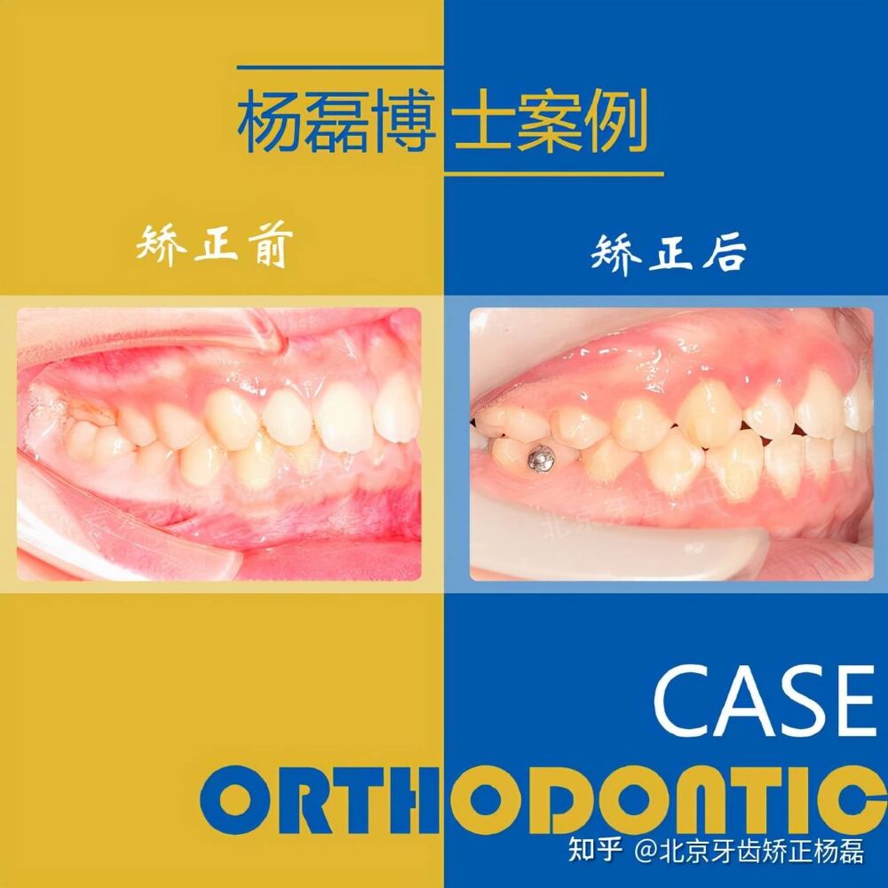 北京牙齿矫正｜隐适美不拔牙正畸改善龅牙嘴突笑线不调