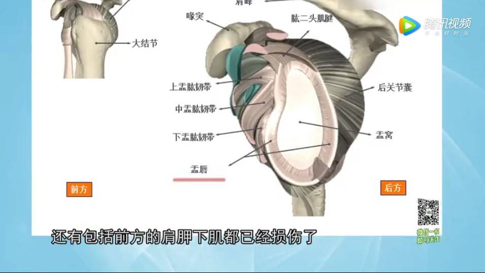 有一种肩痛，比肩周炎可怕，会致残！教你如何区分危险的肩痛