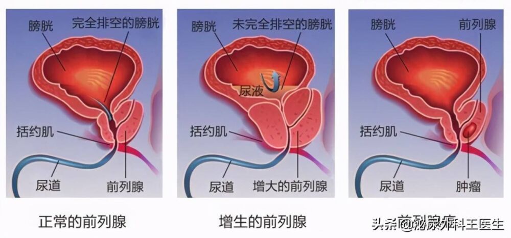 女性也有前列腺？为何只有男性发病？其中原因医生一次讲清