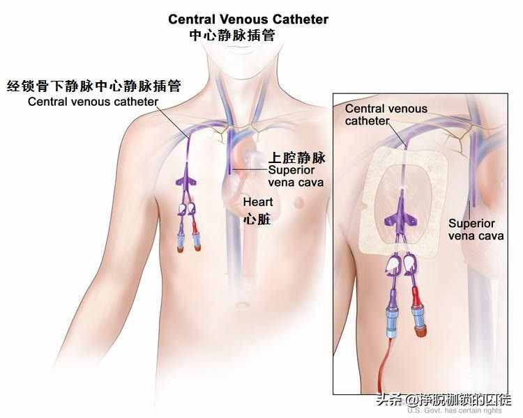 输液时如果空气进入了血管，会有什么后果？