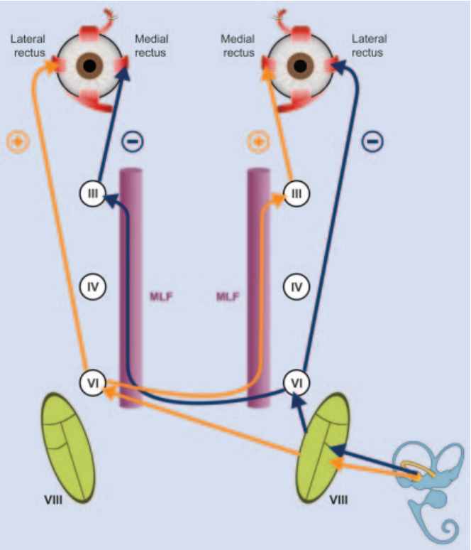 临床解惑：前庭水平眼震的快相，是如何产生的？