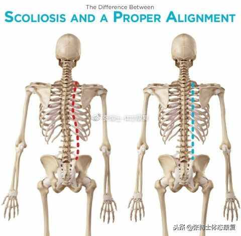 「译文分享」关于脊柱侧弯的综述：原因、类型、康复与运动建议