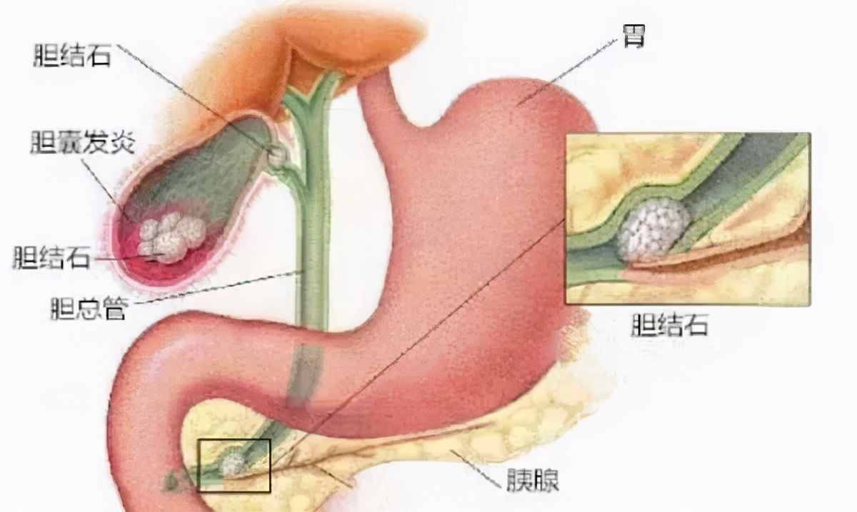 带你一分钟了解胆囊炎 还不赶紧学起来