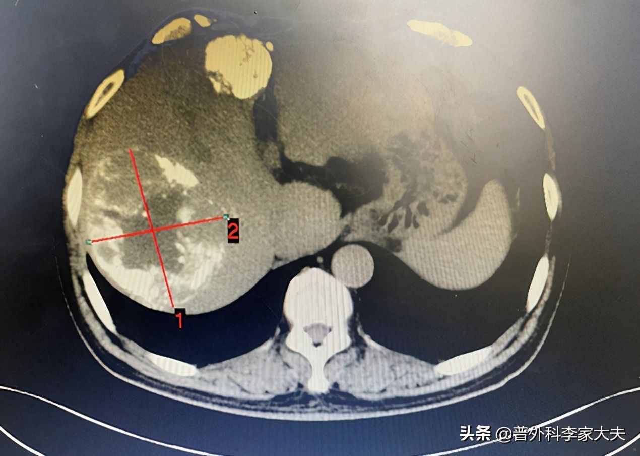 谈谈晚期肝癌的治疗