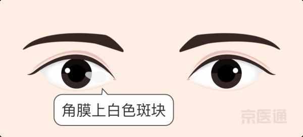 同仁眼科专家：看着很吓人的3种病，其实不用治