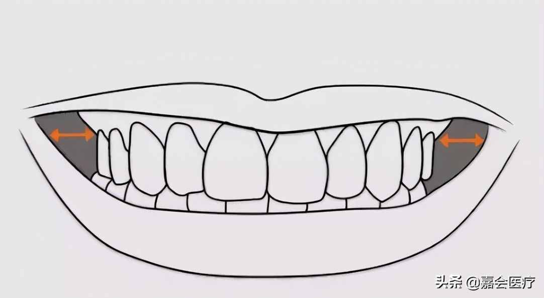 已经成年，还能做牙齿矫正吗？口腔科医生告诉你答案