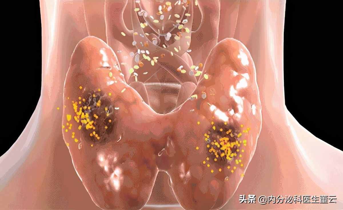 别只盯着“大脖子”！医生：有这4种症状，也说明甲亢来了