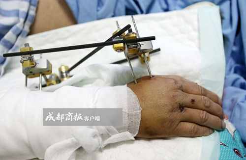 视频｜四川41岁硕士饲养员被大熊猫咬成重伤 左手掌几乎被咬掉
