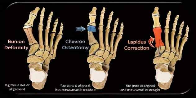 拇外翻矫正带为何不能有效矫正大脚骨？别被收了智商税