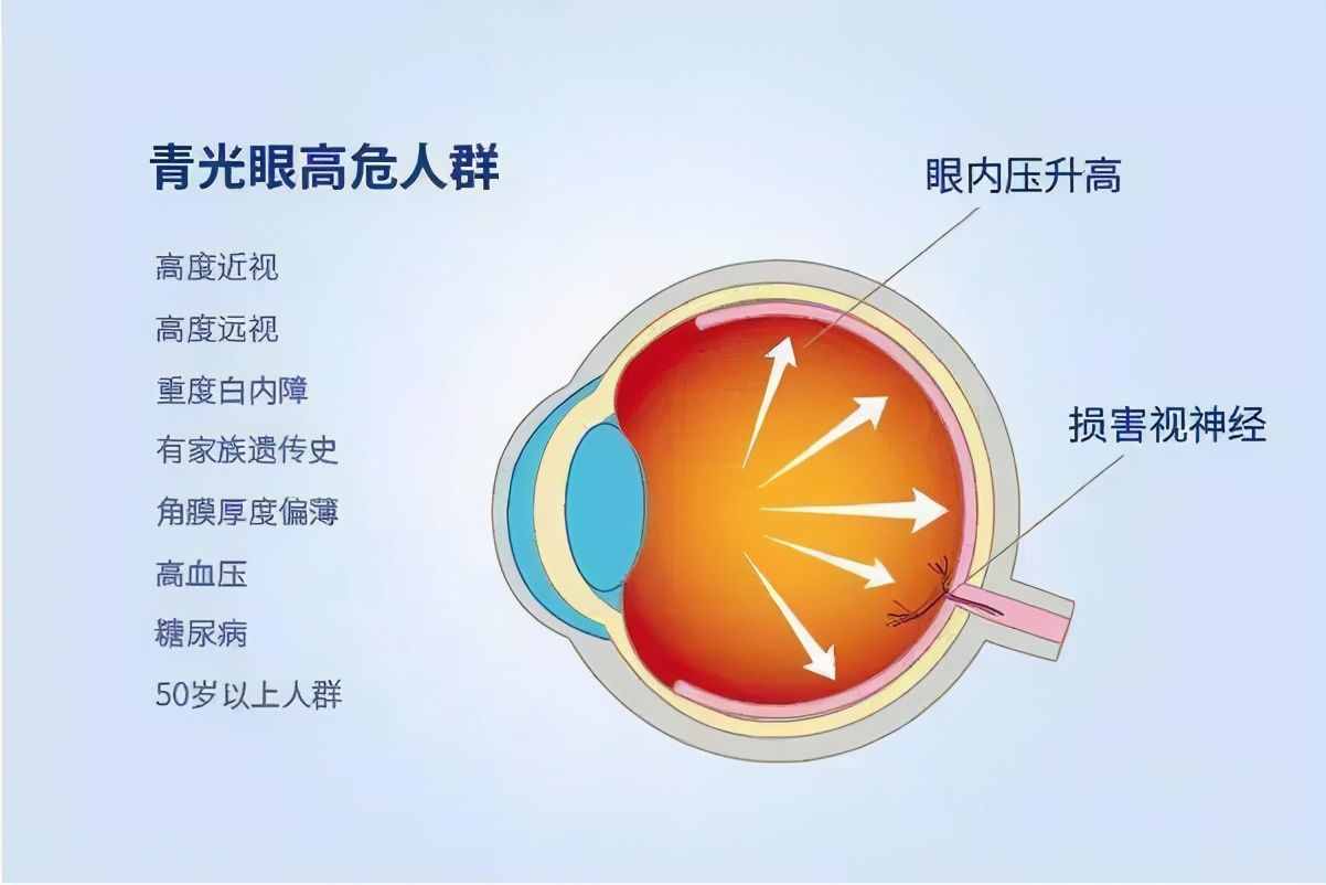 眼胀眼痛、头痛头胀伴欲呕吐，眼科的急症-青光眼，你了解多少？