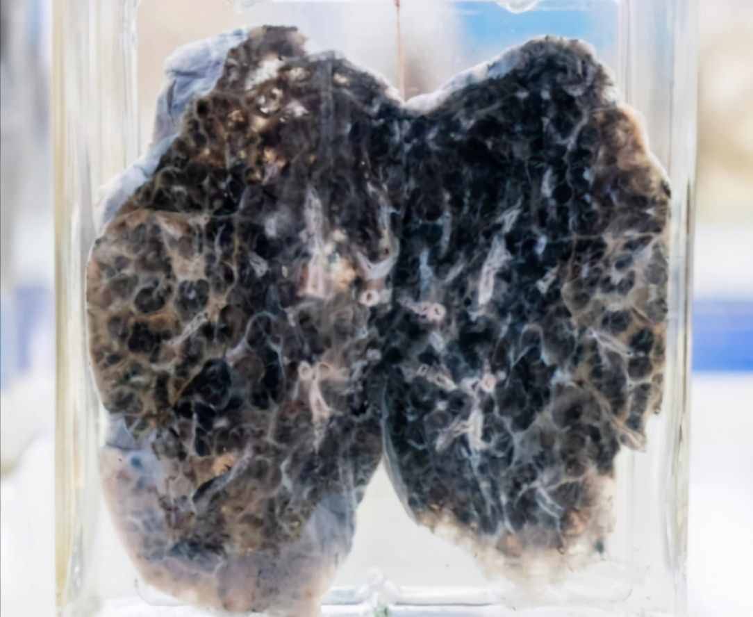 肺癌复发和转移的原因是什么？医生用CT片举例说明
