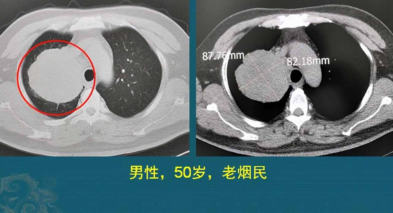 肺癌复发和转移的原因是什么？医生用CT片举例说明