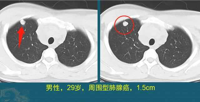 肺癌复发和转移的原因是什么？医生用CT片举例说明