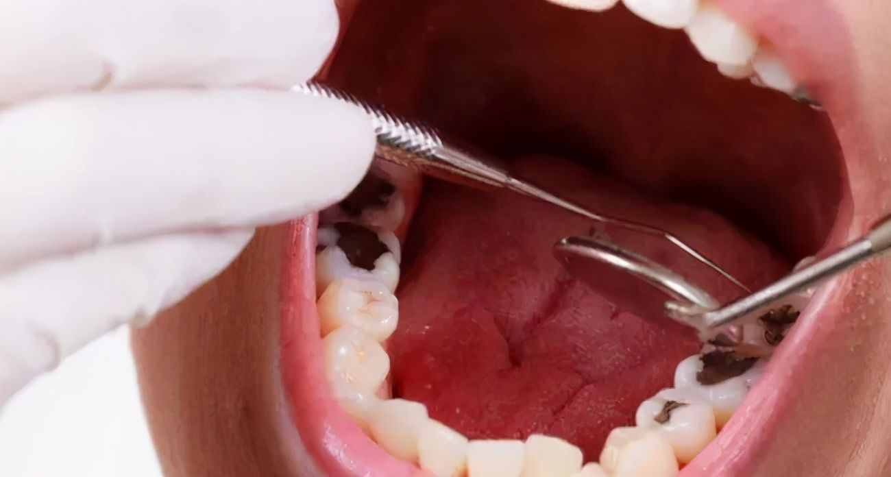 牙齿残根会带来口腔癌？男性口腔癌风险更高？权威解答来了