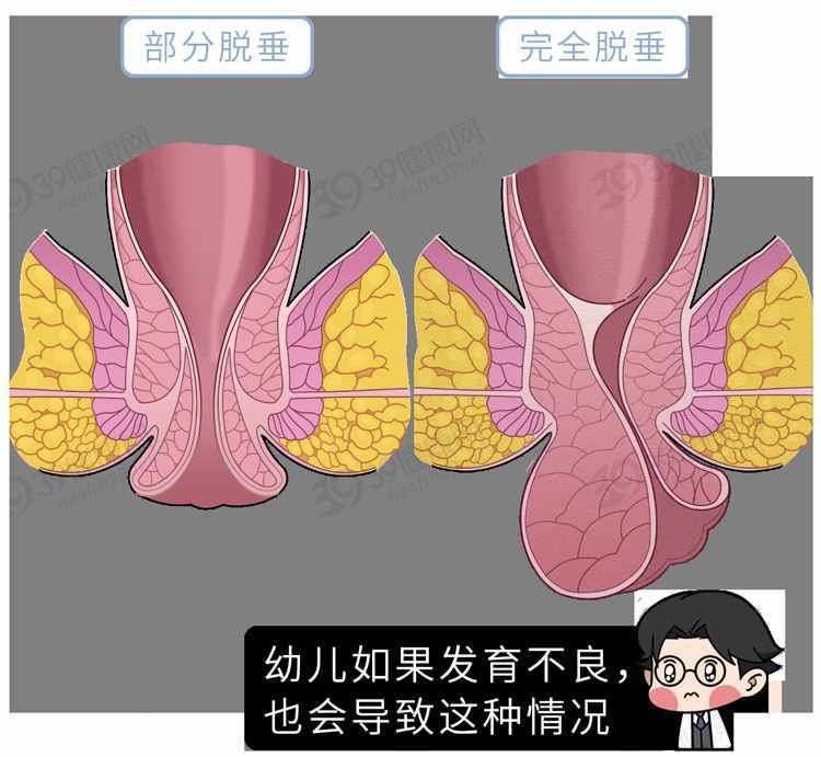 排便时，肛门掉出一块肉是怎么回事？这5类人易被“脱肛”盯上