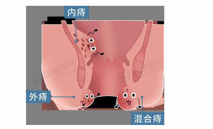 排便时，肛门掉出一块肉是怎么回事？这5类人易被“脱肛”盯上