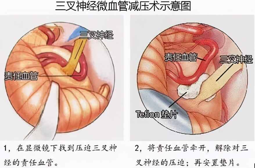 三叉神经痛吃药有效吗？应该如何治疗？