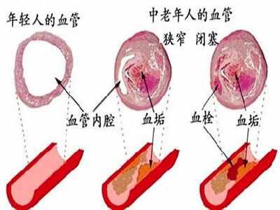 脑血栓的原因和解决方法