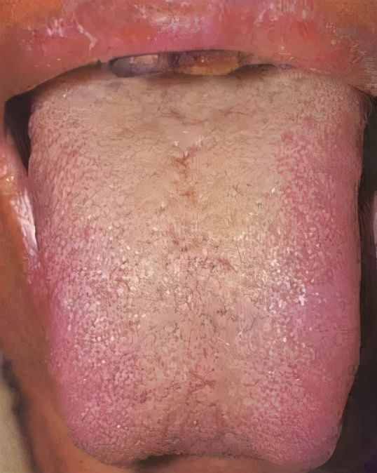 舌苔厚腻就是湿气重？2个中医祛湿方，帮你搞定厚腻苔