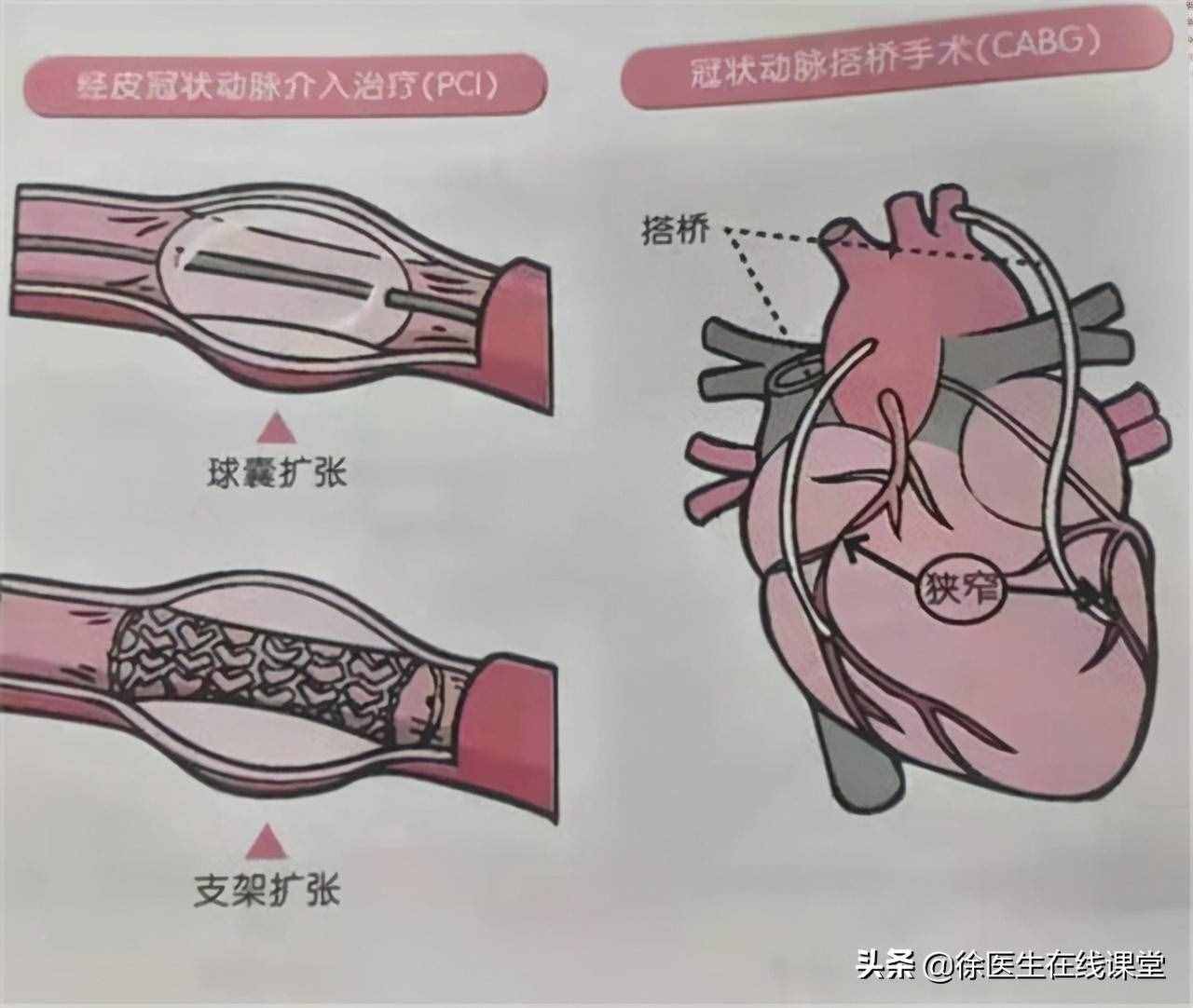 做冠脉造影后活不长？冠脉造影对人有这些危害，2种人别轻易尝试