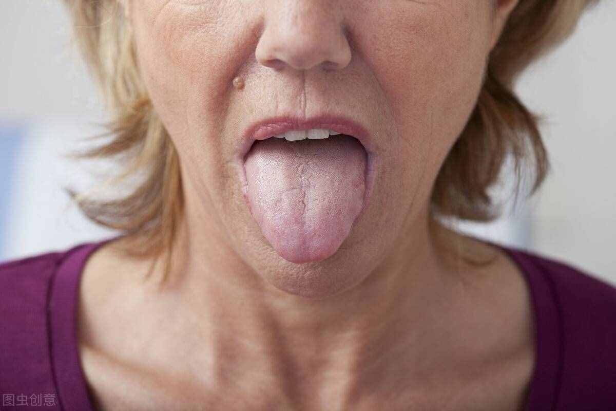 什么是舌癌？舌头出现这些现象，可能得找医生看看