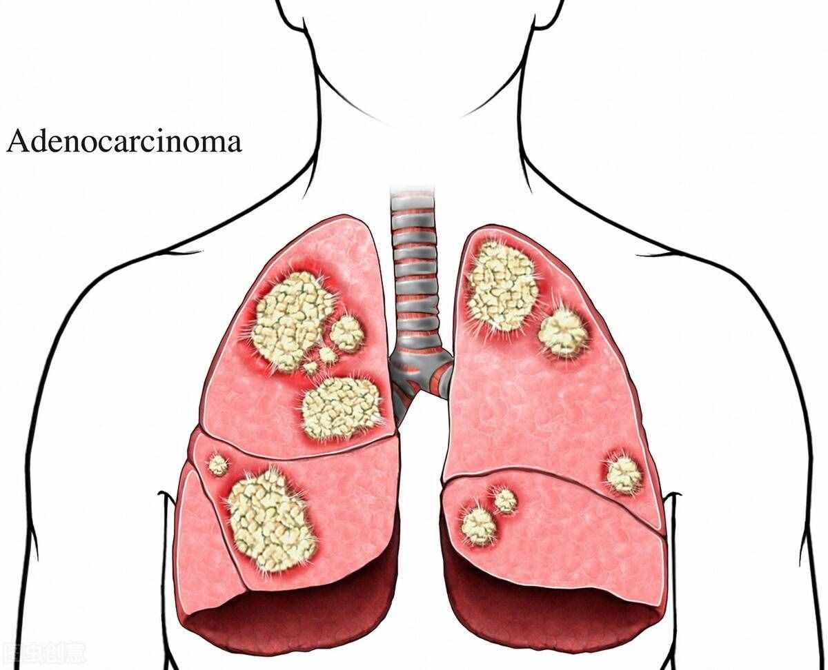 三种肺癌类型，哪种更难治疗